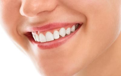 Teeth Whitening – Is It Worth It?