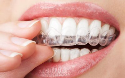 Why Are Invisalign Clear Braces So Popular?
