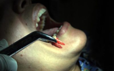 Does Getting A Tooth Pulled Hurt?