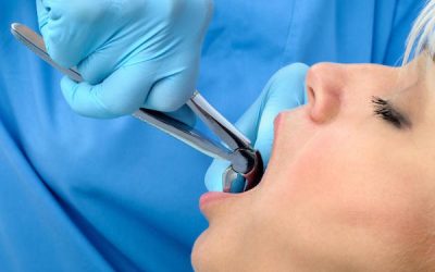 Smoking After Tooth Extraction