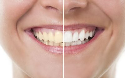 How Important Is Teeth Whitening?