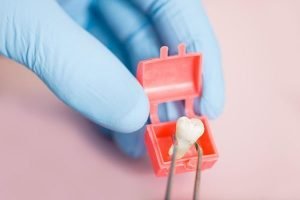 Wisdom Teeth Extraction | Dentist Forster