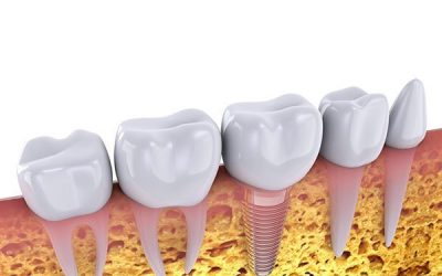 Dental Implants Procedure in Forster Dental Centre