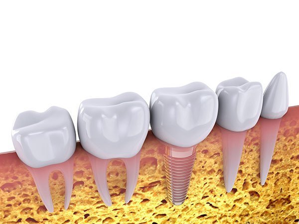 Dental Implants Procedure in Forster Dental Centre