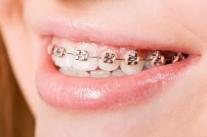 Orthodontics | Dentist Forster