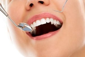 Tooth Coloured Fillings | Dentist Forster