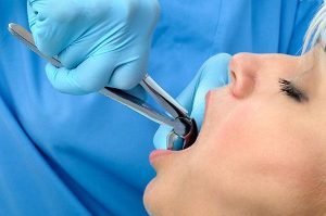 Tooth Extraction | Dentist Forster