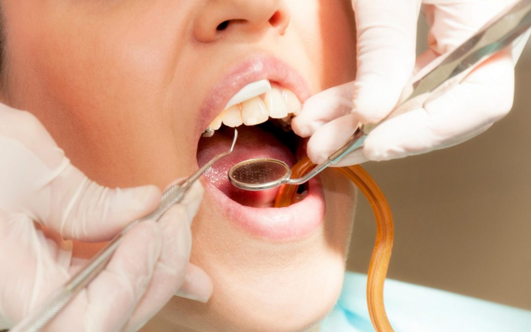 How Long Can I Wait to Treat Tooth Decay?