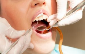 How Long Can I Wait to Treat Tooth Decay | Dentist Forster