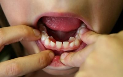 Crooked Teeth Why and What Forster Dental Centre Can Do