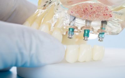 Dental Implants In Forster: The Benefits And Advantages