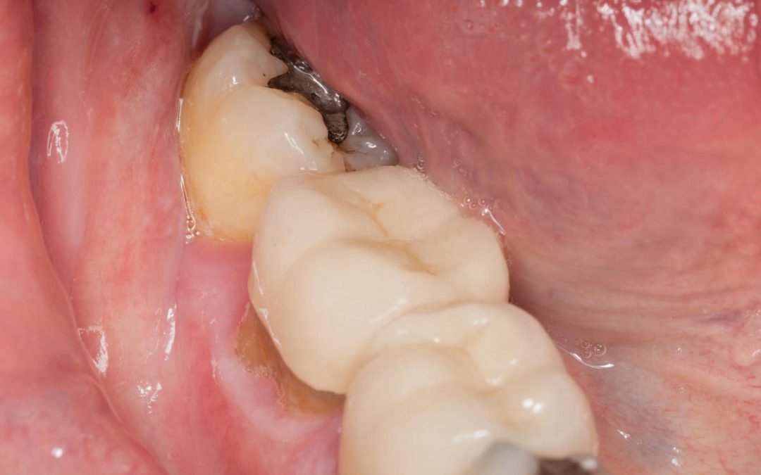Dental Guide: Lost and Damaged Fillings – What to Do