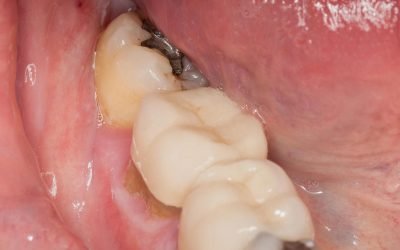 Dental Guide: Lost and Damaged Fillings – What to Do