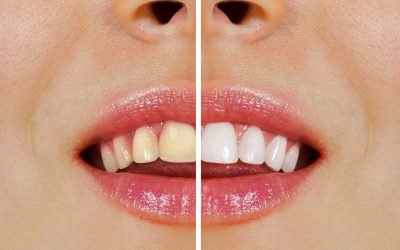 Over-the-Counter Whitening vs Professional Whitening at Forster Dental Centre