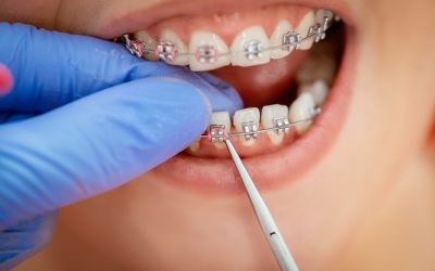 Braces and Missing Teeth – Can They Go Together?