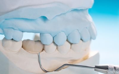 How Long Will Dental Crowns Last? Answers from Forster Dental Centre