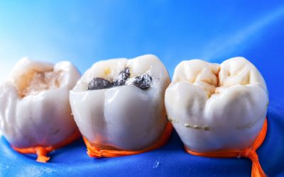 How to Choose the Best Dental Fillings in Forster
